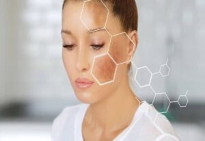 Cách điều trị nám da hiệu quả nhất hiện nay